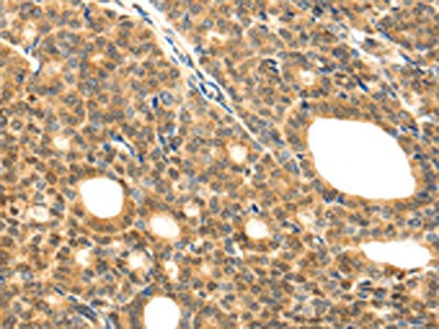 The image on the left is immunohistochemistry of paraffin-embedded Human thyroid cancer tissue using the antibody Antibody) at dilution 1/20, on the right is treated with fusion protein. (Original magnification: ×200)