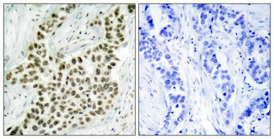 Immunohistochemical analysis of paraffin-embedded human breast carcinoma tissue using Histone H2A.X(Ab-139) Antibody(left) or the same antibody preincubated with blocking peptide(right).Rabbit anti-Human H2AFX Polyclonal Antibody