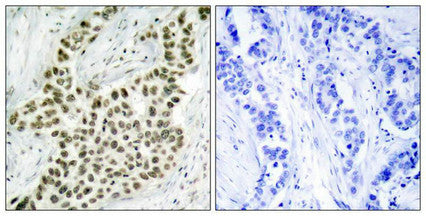 Immunohistochemical analysis of paraffin-embedded human breast carcinoma tissue using Histone H2A.X(Ab-139) Antibody(left) or the same antibody preincubated with blocking peptide(right).Rabbit anti-Human H2AFX Polyclonal Antibody
