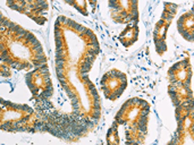 The image on the left is immunohistochemistry of paraffin-embedded Human colon cancer tissue using SUFU Antibody(SUFU Antibody) at dilution 1/10, on the right is treated with fusion protein. (Original magnification: ×200)Rabbit anti-Human SUFU Polyclonal Antibody