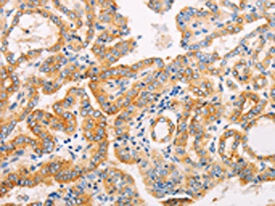 The image on the left is immunohistochemistry of paraffin-embedded Human thyroid cancer tissue using the antibody Antibody) at dilution 1/10, on the right is treated with fusion protein. (Original magnification: ×200)Rabbit anti-Human SUFU Polyclonal Antibody