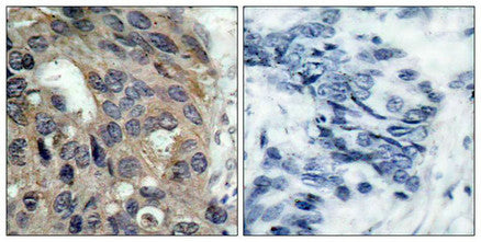Immunohistochemical analysis of paraffin-embedded human breast carcinoma tissue using Src(Phospho-Tyr529) Antibody(left) or the same antibody preincubated with blocking peptide(right).Rabbit anti-Human SRC Polyclonal Antibody