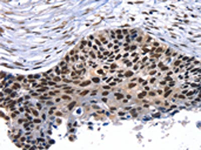 The image on the left is immunohistochemistry of paraffin-embedded Human esophagus cancer tissue using TAF15 Antibody(TAF15 Antibody) at dilution 1/35, on the right is treated with synthetic peptide. (Original magnification: ×200)Rabbit anti-Human TAF15 Polyclonal Antibody