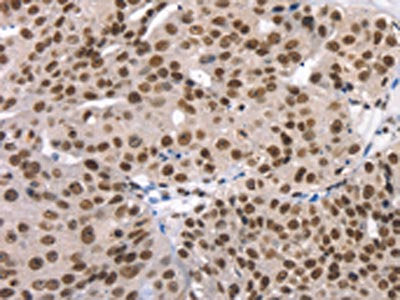 The image on the left is immunohistochemistry of paraffin-embedded Human breast cancer tissue using the antibody Antibody) at dilution 1/35, on the right is treated with synthetic peptide. (Original magnification: ×200)Rabbit anti-Human TAF15 Polyclonal Antibody