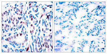 Immunohistochemical analysis of paraffin-embedded human breast carcinoma tissue using STAT3 (Phospho-Tyr705) Antibody (left) or the same antibody preincubated with blocking peptide (right).Rabbit anti-Human STAT3 Polyclonal Antibody