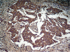 Immunohistochemical analysis of paraffin-embedded human Lung carcinoma tissue using STAT3 (Phospho-Tyr705) Antibody.Rabbit anti-Human STAT3 Polyclonal Antibody