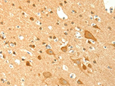 The image on the left is immunohistochemistry of paraffin-embedded Human brain tissue using TRAF6 Antibody(TRAF6 Antibody) at dilution 1/20, on the right is treated with fusion protein. (Original magnification: ×200)Rabbit anti-Human TRAF6 Polyclonal Antibody