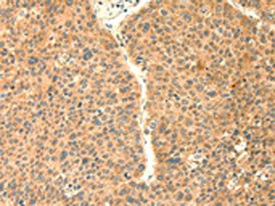 The image on the left is immunohistochemistry of paraffin-embedded Human liver cancer tissue using the antibody Antibody) at dilution 1/20, on the right is treated with fusion protein. (Original magnification: ×200)Rabbit anti-Human TRAF6 Polyclonal Antibody