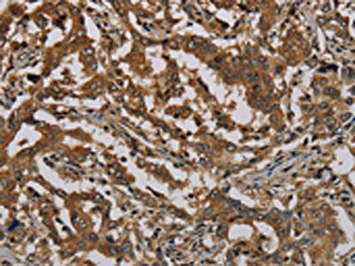 The image on the left is immunohistochemistry of paraffin-embedded Human liver cancer tissue using PKMYT1 Antibody(PKMYT1 Antibody) at dilution 1/50, on the right is treated with synthetic peptide. (Original magnification: ×200)Rabbit anti-Human PKMYT1 Polyclonal Antibody