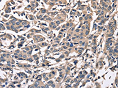 The image on the left is immunohistochemistry of paraffin-embedded Human breast cancer tissue using PEBP1 Antibody(PEBP1 Antibody) at dilution 1/50, on the right is treated with fusion protein. (Original magnification: ×200)Rabbit anti-Human PEBP1 Polyclonal Antibody