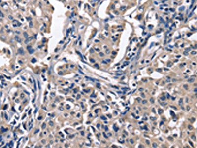 The image on the left is immunohistochemistry of paraffin-embedded Human lung cancer tissue using the antibody Antibody) at dilution 1/50, on the right is treated with fusion protein. (Original magnification: ×200)Rabbit anti-Human PEBP1 Polyclonal Antibody