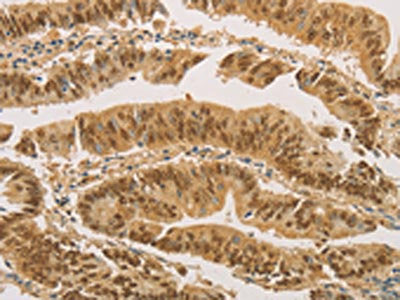 The image on the left is immunohistochemistry of paraffin-embedded Human colon cancer tissue using PSMB7 Antibody(PSMB7 Antibody) at dilution 1/20, on the right is treated with fusion protein. (Original magnification: ×200)Rabbit anti-Human PSMB7 Polyclonal Antibody