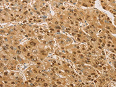 The image on the left is immunohistochemistry of paraffin-embedded Human liver cancer tissue using the antibody Antibody) at dilution 1/20, on the right is treated with fusion protein. (Original magnification: ×200)Rabbit anti-Human PSMB7 Polyclonal Antibody