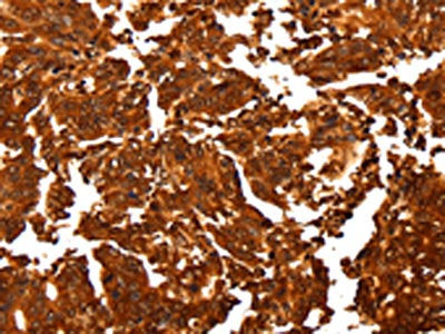 The image on the left is immunohistochemistry of paraffin-embedded Human gastic cancer tissue using ALDOA Antibody(ALDOA Antibody) at dilution 1/30, on the right is treated with fusion protein. (Original magnification: ×200)Rabbit anti-Human ALDOA Polyclonal Antibody