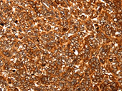 The image on the left is immunohistochemistry of paraffin-embedded Human ovarian cancer tissue using the antibody Antibody) at dilution 1/30, on the right is treated with fusion protein. (Original magnification: ×200)Rabbit anti-Human ALDOA Polyclonal Antibody