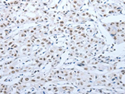 The image on the left is immunohistochemistry of paraffin-embedded Human lung cancer tissue using ACIN1 Antibody(ACIN1 Antibody) at dilution 1/30, on the right is treated with synthetic peptide. (Original magnification: X200)