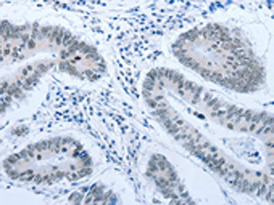 The image on the left is immunohistochemistry of paraffin-embedded Human colon cancer tissue using the antibody Antibody) at dilution 1/30, on the right is treated with synthetic peptide. (Original magnification: X200)