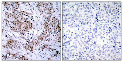 Immunohistochemical analysis of paraffin-embedded human breast carcinoma tissue using Estrogen Receptor-a(Ab-167) Antibody(left) or the same antibody preincubated with blocking peptide(right).Rabbit anti-Human ESR1 Polyclonal Antibody