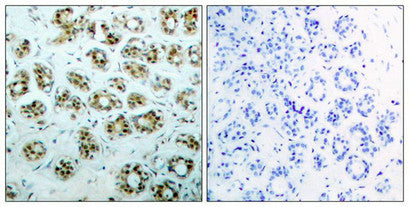 Immunohistochemical analysis of paraffin-embedded human breast carcinoma tissue, using NFκB-p65 (phospho-Ser311) antibody.Rabbit anti-Human RELA Polyclonal Antibody