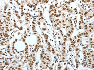 The image on the left is immunohistochemistry of paraffin-embedded Human breast cancer tissue using BNIP1 Antibody(BNIP1 Antibody) at dilution 1/60, on the right is treated with fusion protein. (Original magnification: ×200)