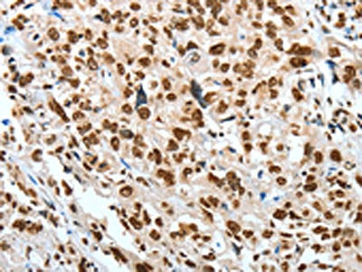 The image on the left is immunohistochemistry of paraffin-embedded Human esophagus cancer tissue using the antibody Antibody) at dilution 1/60, on the right is treated with fusion protein. (Original magnification: ×200)