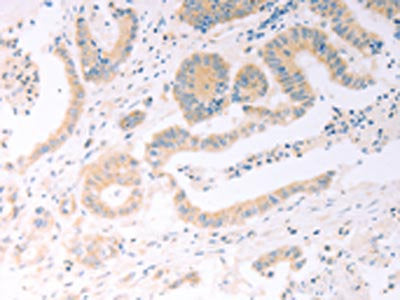 The image on the left is immunohistochemistry of paraffin-embedded Human colon cancer tissue using TRIM32 Antibody(TRIM32 Antibody) at dilution 1/25, on the right is treated with fusion protein. (Original magnification: ×200)Rabbit anti-Human TRIM32 Polyclonal Antibody