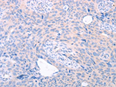 The image on the left is immunohistochemistry of paraffin-embedded Human cervical cancer tissue using the antibody Antibody) at dilution 1/25, on the right is treated with fusion protein. (Original magnification: ×200)Rabbit anti-Human TRIM32 Polyclonal Antibody