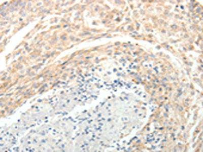 The image on the left is immunohistochemistry of paraffin-embedded Human cervical cancer  tissue using SOCS3 Antibody(SOCS3 Antibody) at dilution 1/25, on the right is treated with fusion protein. (Original magnification: ×200)Rabbit anti-Human SOCS3 Polyclonal Antibody