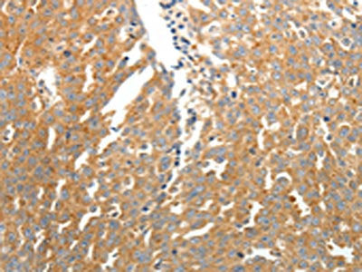 The image on the left is immunohistochemistry of paraffin-embedded Human ovarian cancer  tissue using the antibody Antibody) at dilution 1/25, on the right is treated with fusion protein. (Original magnification: ×200)Rabbit anti-Human SOCS3 Polyclonal Antibody