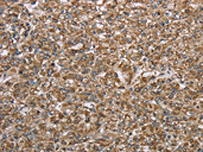 The image on the left is immunohistochemistry of paraffin-embedded Human prostate cancer tissue using CERS4 Antibody(CERS4 Antibody) at dilution 1/35, on the right is treated with synthetic peptide. (Original magnification: ×200)Rabbit anti-Human CERS4 Polyclonal Antibody