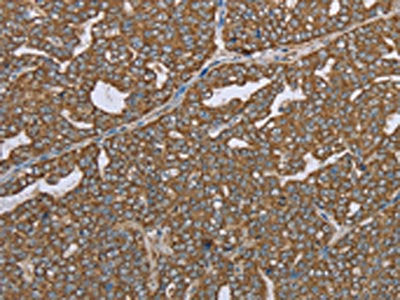 The image on the left is immunohistochemistry of paraffin-embedded Human ovarian cancer tissue using the antibody Antibody) at dilution 1/35, on the right is treated with synthetic peptide. (Original magnification: ×200)Rabbit anti-Human CERS4 Polyclonal Antibody