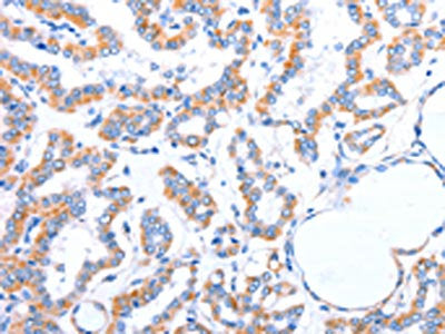 The image on the left is immunohistochemistry of paraffin-embedded Human thyroid cancer tissue using ACADS Antibody(ACADS Antibody) at dilution 1/20, on the right is treated with fusion protein. (Original magnification: ×200)