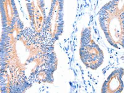 The image on the left is immunohistochemistry of paraffin-embedded Human colon cancer tissue using the antibody Antibody) at dilution 1/20, on the right is treated with fusion protein. (Original magnification: ×200)