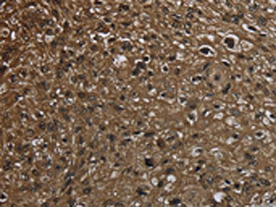 The image on the left is immunohistochemistry of paraffin-embedded Human esophagus cancer tissue using GLO1 Antibody(GLO1 Antibody) at dilution 1/50, on the right is treated with fusion protein. (Original magnification: ×200)Rabbit anti-Human GLO1 Polyclonal Antibody