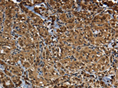 The image on the left is immunohistochemistry of paraffin-embedded Human thyroid cancer tissue using the antibody Antibody) at dilution 1/50, on the right is treated with fusion protein. (Original magnification: ×200)Rabbit anti-Human GLO1 Polyclonal Antibody