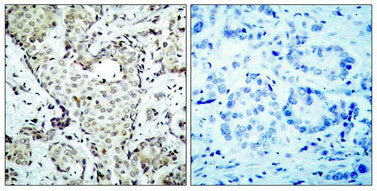 Immunohistochemical analysis of paraffin-embedded human breast carcinoma tissue using MKK6(Ab-207) Antibody(left) or the same antibody preincubated with blocking peptide(right).Rabbit anti-Human MAP2K6 Polyclonal Antibody