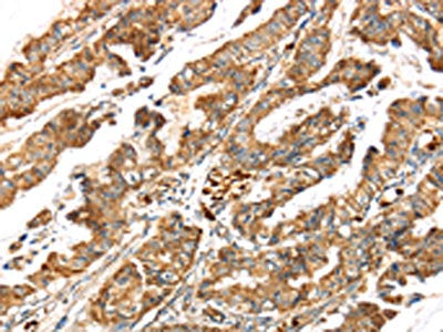 The image on the left is immunohistochemistry of paraffin-embedded Human esophagus cancer tissue using LONP1 Antibody(LONP1 Antibody) at dilution 1/25, on the right is treated with synthetic peptide. (Original magnification: ×200)Rabbit anti-Human LONP1 Polyclonal Antibody
