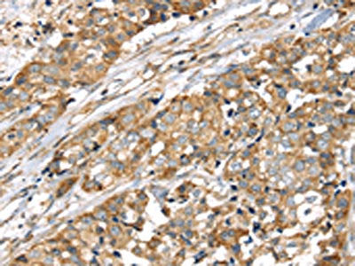 The image on the left is immunohistochemistry of paraffin-embedded Human breast cancer tissue using the antibody Antibody) at dilution 1/25, on the right is treated with synthetic peptide. (Original magnification: ×200)