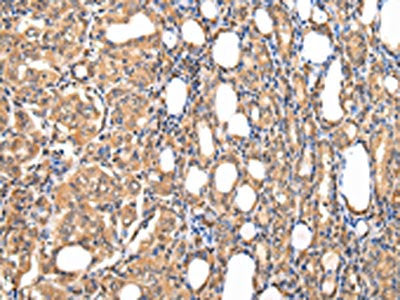 The image on the left is immunohistochemistry of paraffin-embedded Human thyroid cancer tissue using STRAP Antibody(STRAP Antibody) at dilution 1/25, on the right is treated with fusion protein. (Original magnification: ×200)Rabbit anti-Human STRAP Polyclonal Antibody