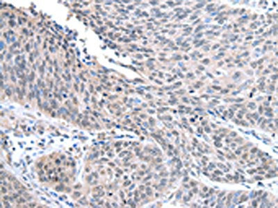 The image on the left is immunohistochemistry of paraffin-embedded Human lung cancer tissue using the antibody Antibody) at dilution 1/25, on the right is treated with fusion protein. (Original magnification: ×200)Rabbit anti-Human STRAP Polyclonal Antibody