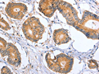 The image on the left is immunohistochemistry of paraffin-embedded Human colon cancer tissue using BLNK Antibody(BLNK Antibody) at dilution 1/50, on the right is treated with synthetic peptide. (Original magnification: ×200)