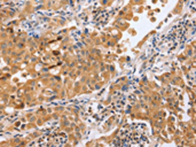 The image on the left is immunohistochemistry of paraffin-embedded Human lung cancer tissue using the antibody Antibody) at dilution 1/50, on the right is treated with synthetic peptide. (Original magnification: ×200)