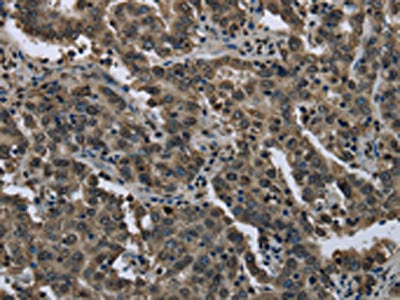 The image on the left is immunohistochemistry of paraffin-embedded Human liver cancer tissue using FTO Antibody(FTO Antibody) at dilution 1/60, on the right is treated with fusion protein. (Original magnification: ×200)Rabbit anti-Human FTO Polyclonal Antibody