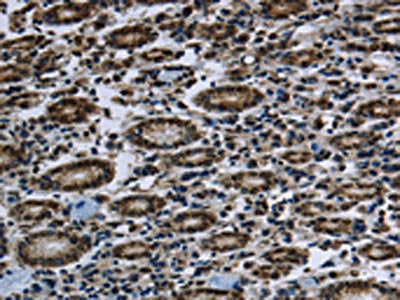 The image on the left is immunohistochemistry of paraffin-embedded Human gastic cancer tissue using the antibody Antibody) at dilution 1/60, on the right is treated with fusion protein. (Original magnification: ×200)Rabbit anti-Human FTO Polyclonal Antibody