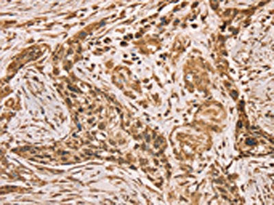 The image on the left is immunohistochemistry of paraffin-embedded Human esophagus cancer tissue using the antibody Antibody) at dilution 1/40, on the right is treated with synthetic peptide. (Original magnification: ×200)Rabbit anti-Human HIF1AN Polyclonal Antibody