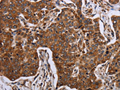 The image on the left is immunohistochemistry of paraffin-embedded Human liver cancer tissue using ACP6 Antibody(ACP6 Antibody) at dilution 1/30, on the right is treated with fusion protein. (Original magnification: ×200)Rabbit anti-Human ACP6 Polyclonal Antibody