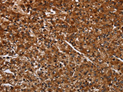 The image on the left is immunohistochemistry of paraffin-embedded Human prostate cancer tissue using the antibody Antibody) at dilution 1/30, on the right is treated with fusion protein. (Original magnification: ×200)