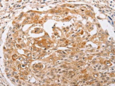 The image on the left is immunohistochemistry of paraffin-embedded Human cervical cancer tissue using PPP1CB Antibody(PPP1CB Antibody) at dilution 1/30, on the right is treated with fusion protein. (Original magnification: ×200)Rabbit anti-Human PPP1CB Polyclonal Antibody