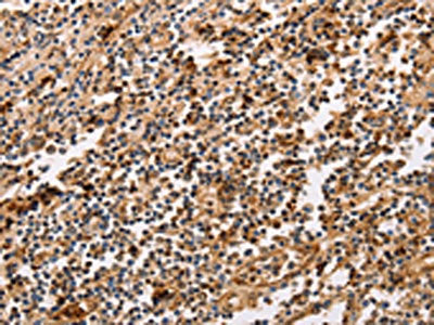 The image on the left is immunohistochemistry of paraffin-embedded Human tonsil tissue using the antibody Antibody) at dilution 1/30, on the right is treated with fusion protein. (Original magnification: ×200)Rabbit anti-Human PPP1CB Polyclonal Antibody