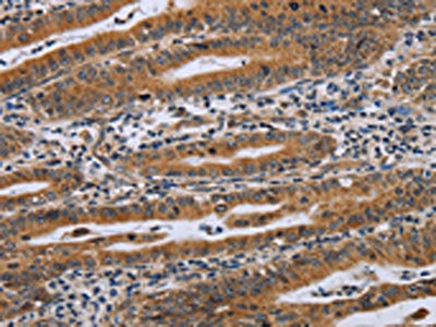 The image on the left is immunohistochemistry of paraffin-embedded Human gastric cancer tissue using NDUFAF4 Antibody(NDUFAF4 Antibody) at dilution 1/45, on the right is treated with synthetic peptide. (Original magnification: ×200)Rabbit anti-Human NDUFAF4 Polyclonal Antibody